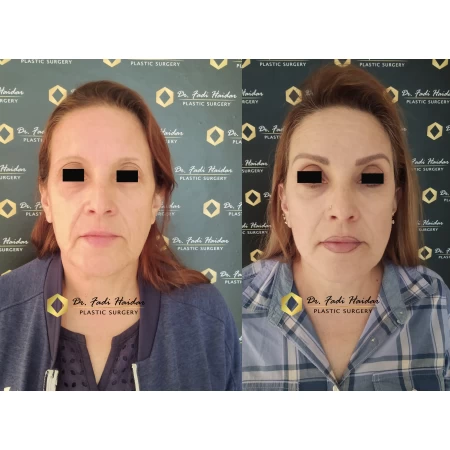 lifting facial resultado 2