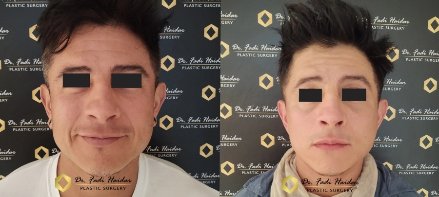 lifting facial resultado 3